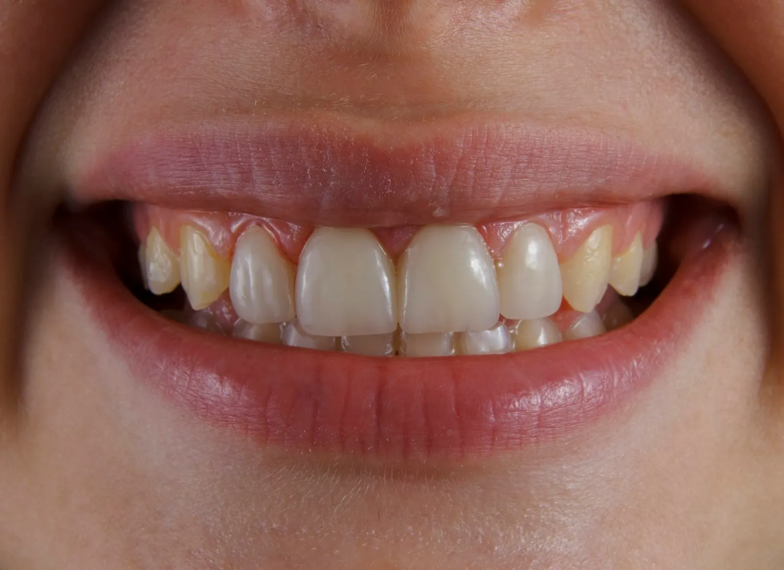 Illustration : dents qui tombent